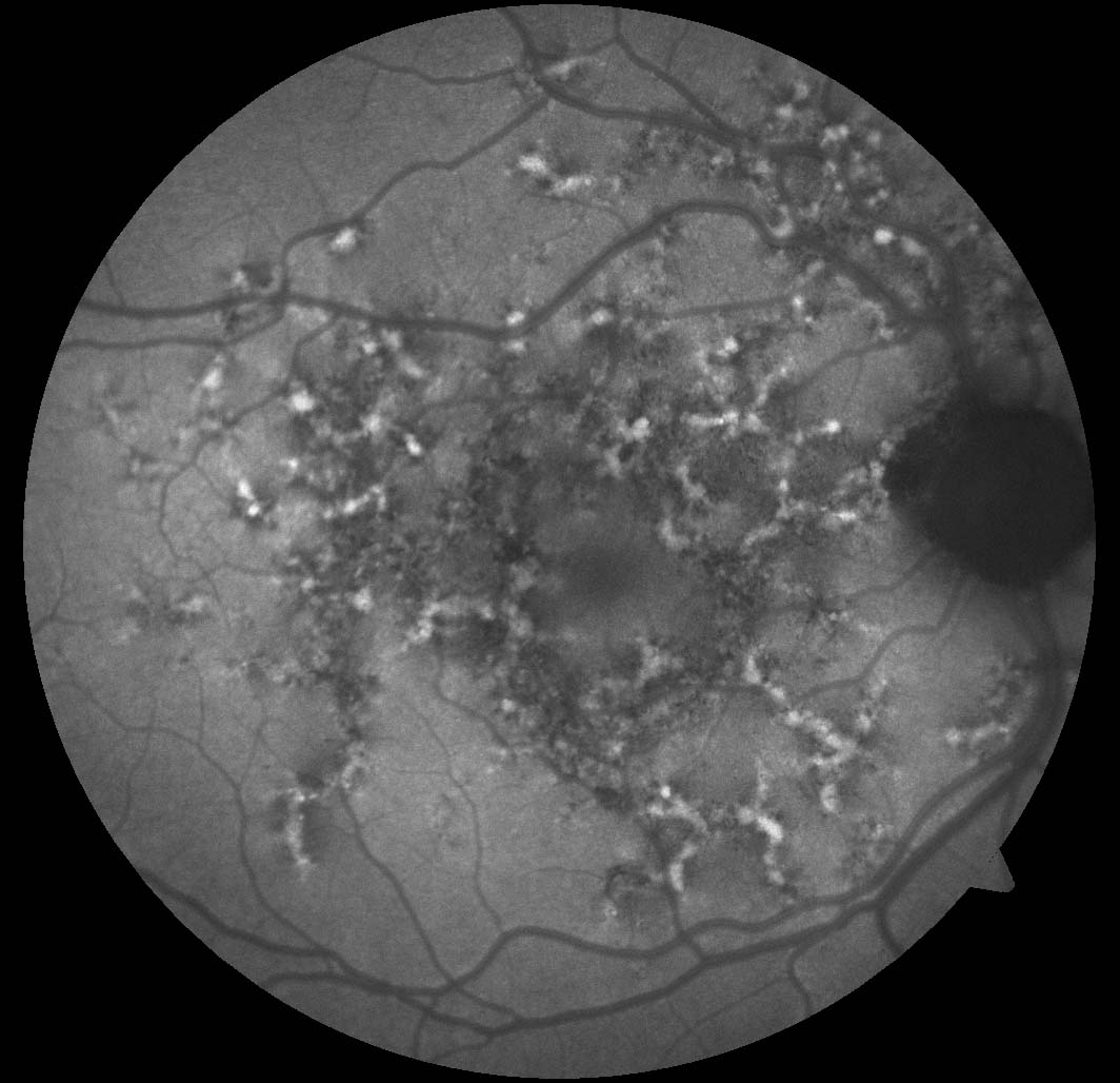 Fundus Autofluorescence Imaging 9 7 Westmead Eye Manual